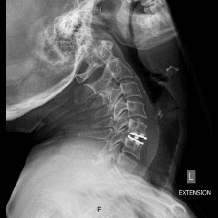 Disc Replacement - Extension