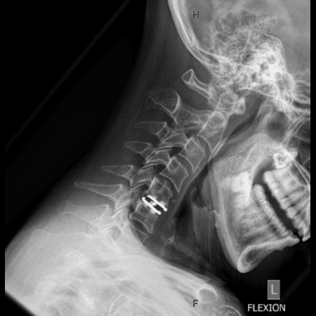 Disc Replacement - Flexion